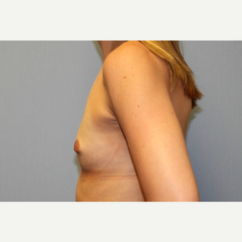 25-34 year old woman treated with Breast Augmentation before 3570057