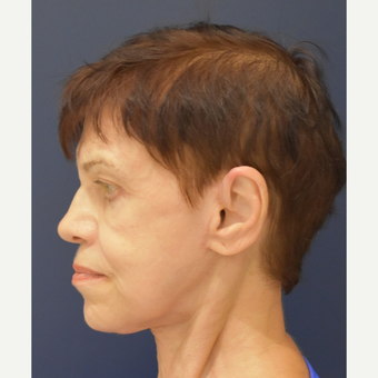 65-74 year old woman treated with Neck Lift after 3449109
