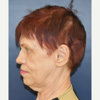 65-74 year old woman treated with Neck Lift before 3449109