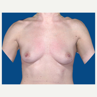 35-44 year old woman treated with Breast Augmentation before 3103842