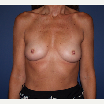 45-54 year old woman treated with Breast Augmentation before 3287411