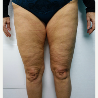 45-54 year old woman treated with Thigh Lift before 3031312