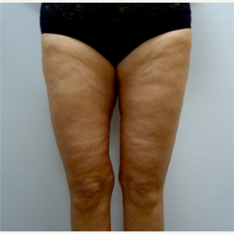 45-54 year old woman treated with Thigh Lift after 3031312