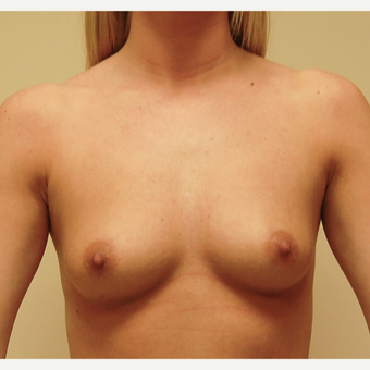 25-34 year old woman treated with Breast Augmentation before 3287712