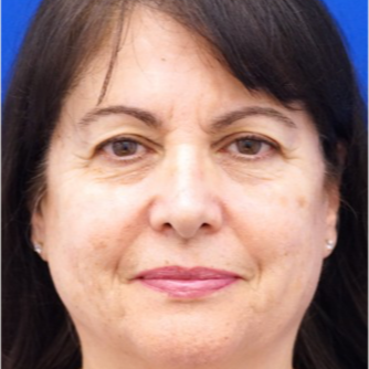 55-64 year old woman treated with Eyelid Surgery before 3678764