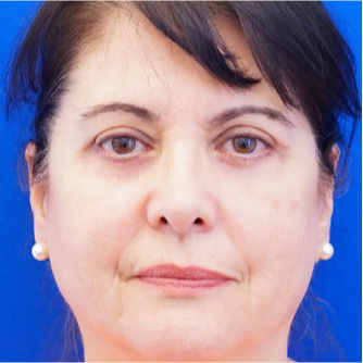 55-64 year old woman treated with Eyelid Surgery after 3678764