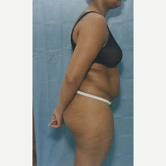 50 year old woman treated with Liposuction of her Abdomen before 1663334
