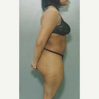 50 year old woman treated with Liposuction of her Abdomen after 1663334