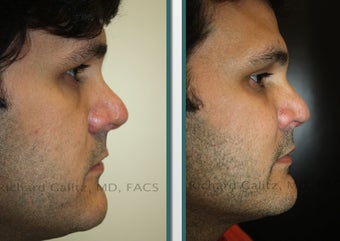 Cheek Implants before 1065305