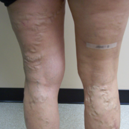VNUS Closures of both legs followed by Ultrasound guided Sclerotherapy before 1576310