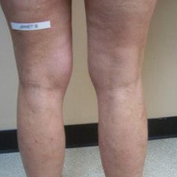 VNUS Closures of both legs followed by Ultrasound guided Sclerotherapy after 1576310