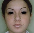 Female patient who underwent ear surgery after 931755