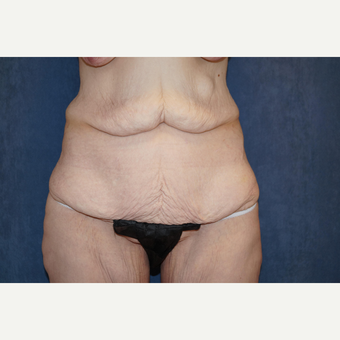 35-44 year old woman treated with Body Lift before 3703594