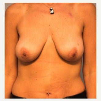 35-44 year old woman treated with Breast Lift with Implants before 2019116