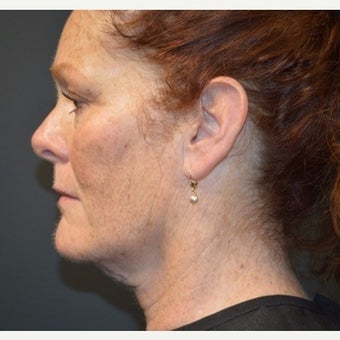 Woman post 3 Kybella treatments before 2221640