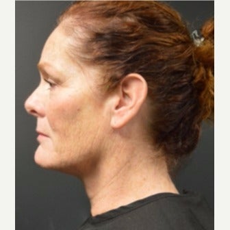 Woman post 3 Kybella treatments after 2221640