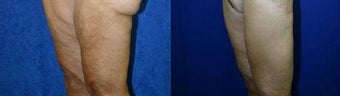 Thigh Lift after massive weight loss before 667185