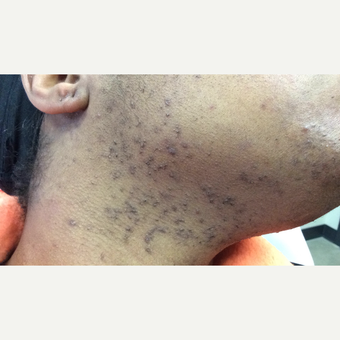 55-64 year old woman treated with Laser Hair Removal Nd:Yag before 2869747