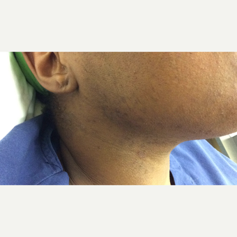 55-64 year old woman treated with Laser Hair Removal Nd:Yag after 2869747