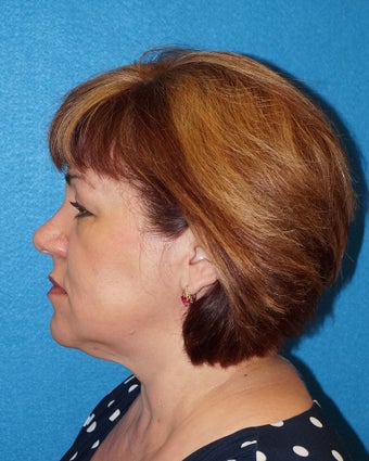 49 year old woman treated with Facelift 3576577