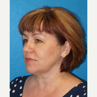 49 year old woman treated with Facelift before 3576577