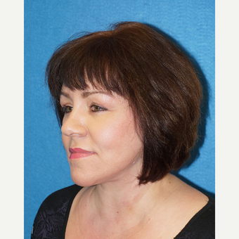 49 year old woman treated with Facelift after 3576577