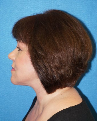 49 year old woman treated with Facelift 3576577