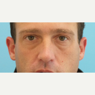 under eye dark circles and bags treated with Restylane filler before 2831220