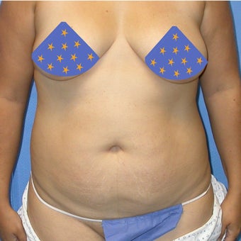 Liposuction of entire trunk 662267