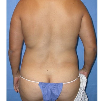 Liposuction of entire trunk before 662267