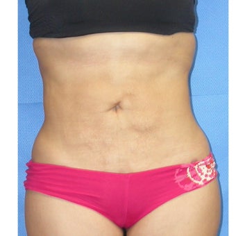 Liposuction of entire trunk 662267