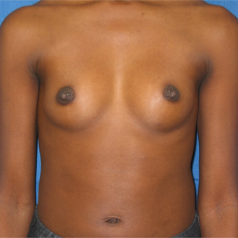 Breast augmentation on petite 5’1 97 pound patient before 3036432