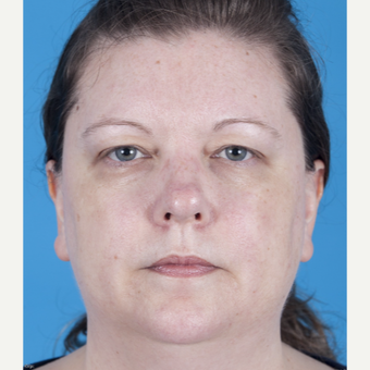 35-44 year old woman treated with Rhinoplasty before 3159524