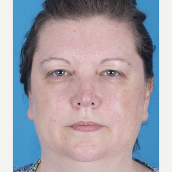 35-44 year old woman treated with Rhinoplasty after 3159524