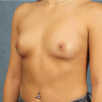 Mentor Breast Implants before 3033668
