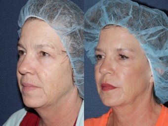 Ulthera Cheeks | Before and After before 1033984