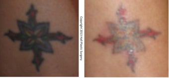 PicoSure Tattoo Removal - Female Patient before 1012424