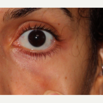 18-24 year old woman treated with CoolTouch Varia after 3149601