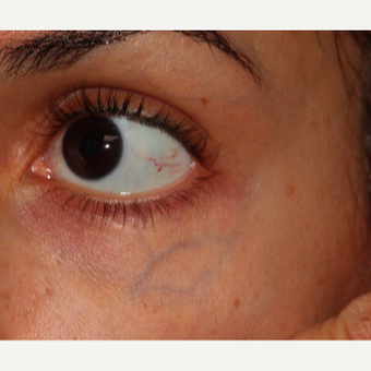 18-24 year old woman treated with CoolTouch Varia before 3149601