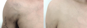 37-year-old man treated with Sclerotherapy for protruding chest veins before 2836135