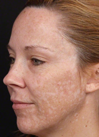 Cosmelan for Melasma Post-Pregnancy before 539843