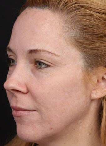 Cosmelan for Melasma Post-Pregnancy after 539843