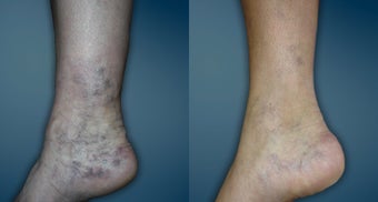 Sclerotherapy of spider veins around the ankle before 1243016