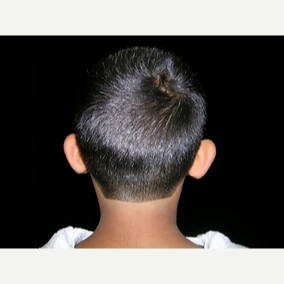 11 year old boy treated with Otoplasty before 3839874