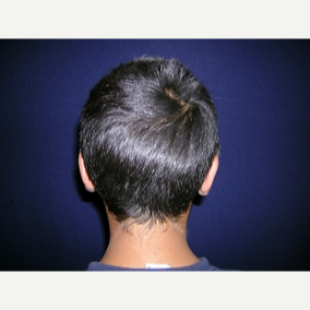 11 year old boy treated with Otoplasty after 3839874