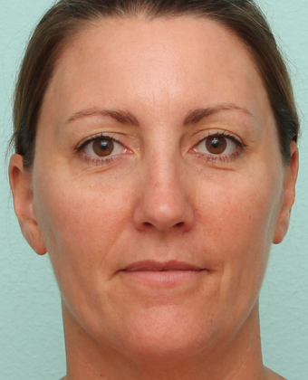 Sciton BroadBand Light (BBL), IPL, MicroLaserPeel after 1039514