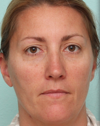 Sciton BroadBand Light (BBL), IPL, MicroLaserPeel before 1039514