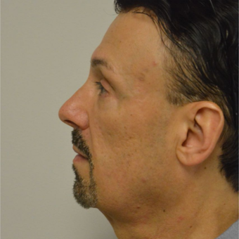 55-64 year old man treated with Perlane after 3042461