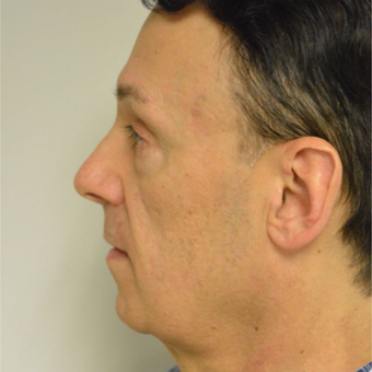 55-64 year old man treated with Perlane before 3042461
