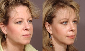 Brow Lift after 460401